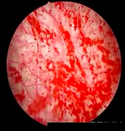 間質性膀胱炎　五月雨状出血の写真02